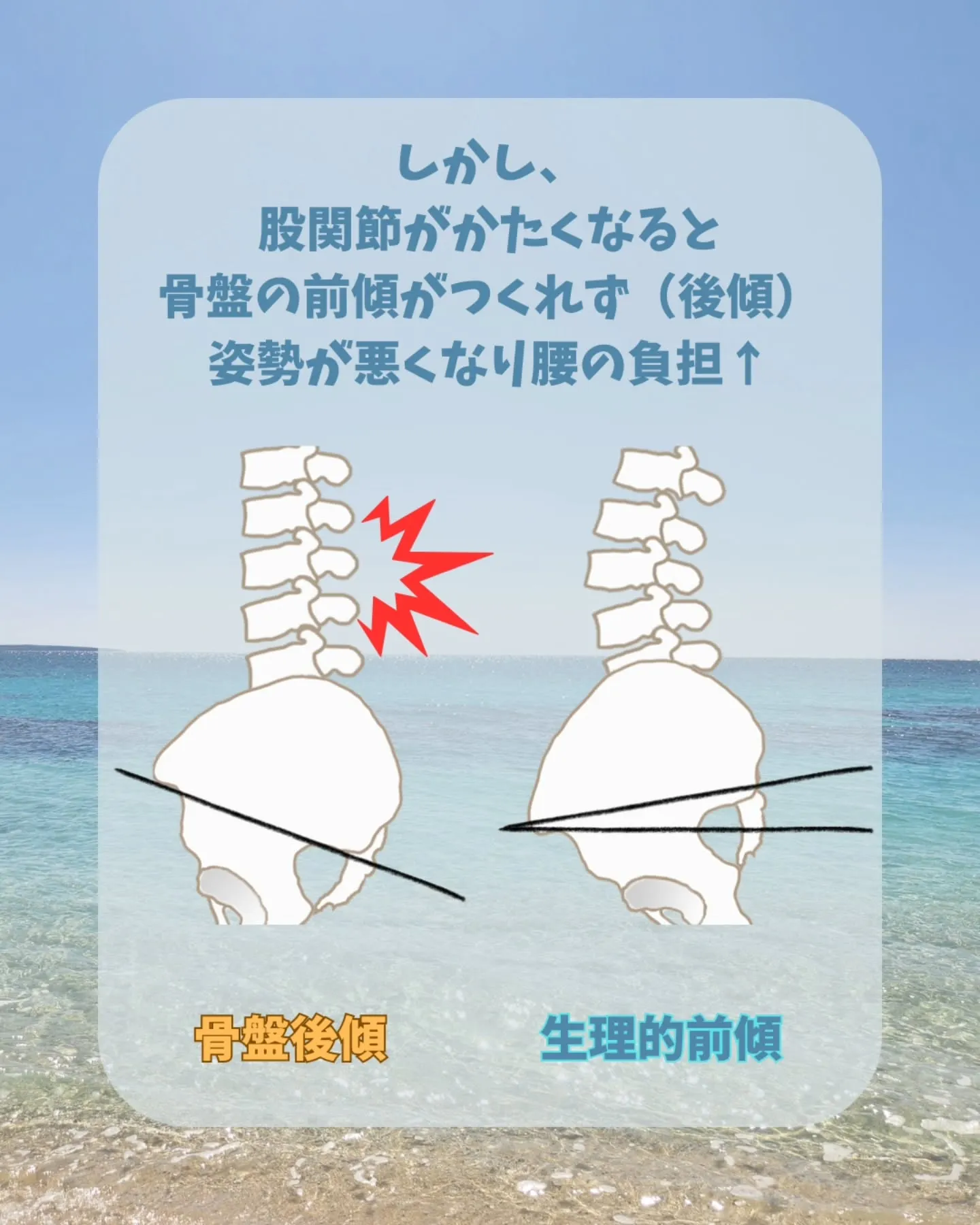 【腰痛の人にありがちな身体のかたさ-股関節-】